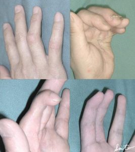 外傷後の指の関節拘縮 指の変形 京都大学医学部附属病院 形成外科