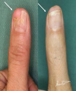 外傷や先天異常の治療後に生じた爪の変形 京都大学医学部附属病院 形成外科